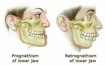 Did You Know Your Breathing Habits Could Be Reshaping Your Face?